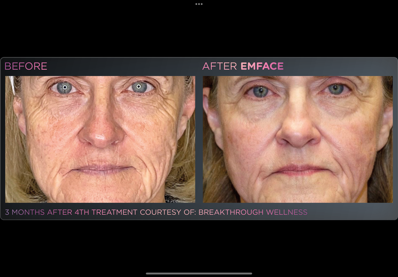 EMFACE NECKLIFT -Holiday Promo