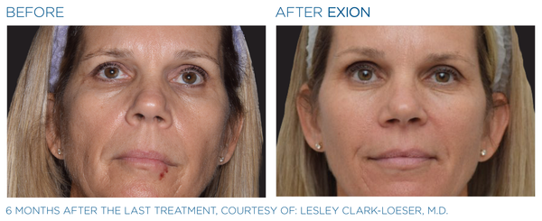 EXION MICRONEEEDLING RF - Buy 3, get 1 FREE