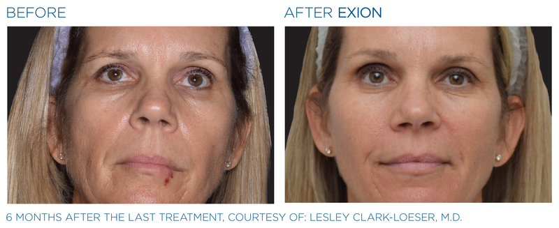 EXION MICRONEEEDLING RF - Buy 3, get 1 FREE