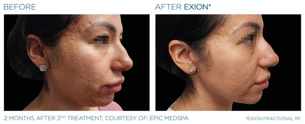 EXION MICRONEEEDLING RF - Buy 3, get 1 FREE