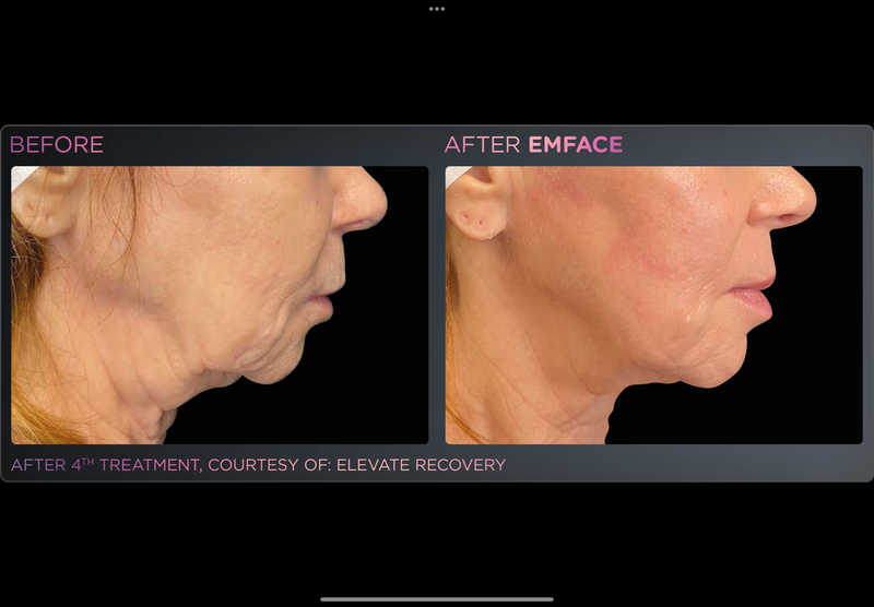 EMFACE NECKLIFT -Holiday Promo