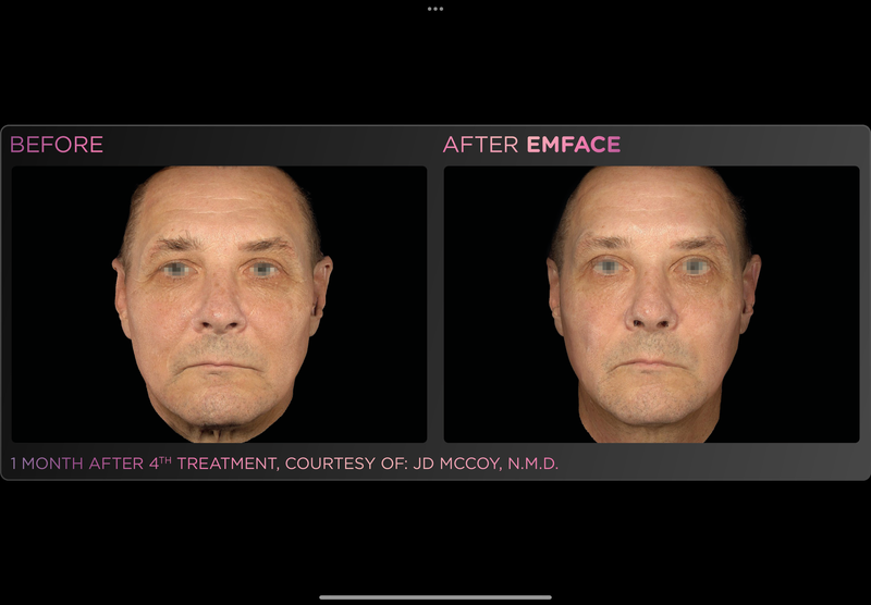 EMFACE NECKLIFT -Holiday Promo