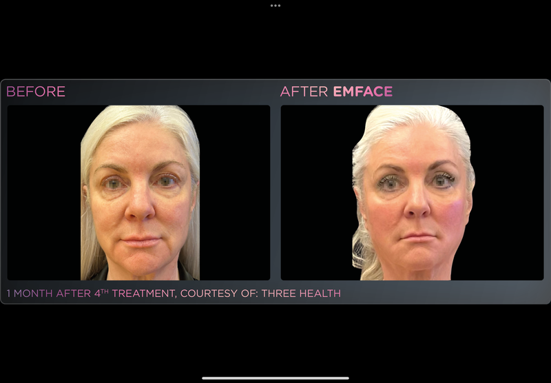 EMFACE NECKLIFT -Holiday Promo