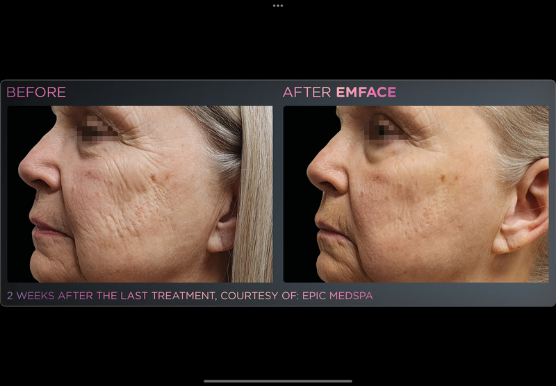 EMFACE NECKLIFT -Holiday Promo