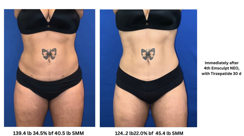 EMSCULPT NEO X10