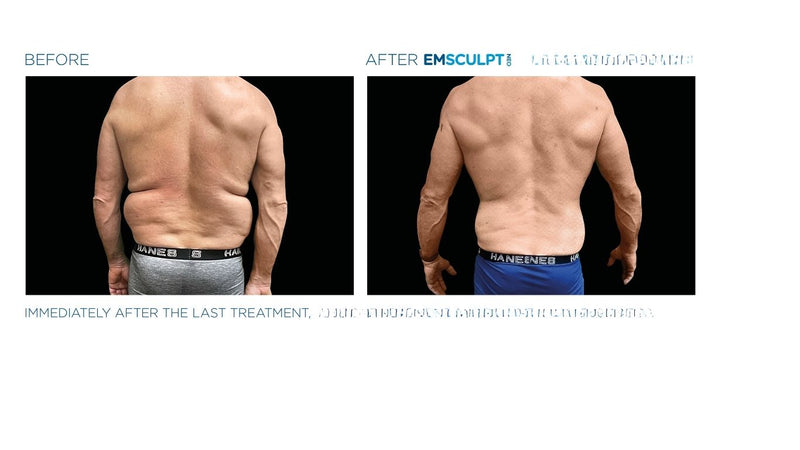 MEGASCULPT - EMSCULPTNEO X 20