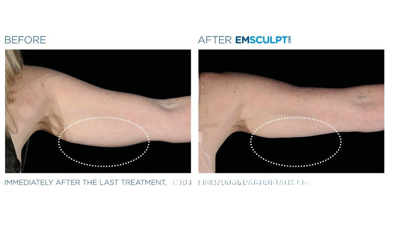 MEGASCULPT - EMSCULPTNEO X 20