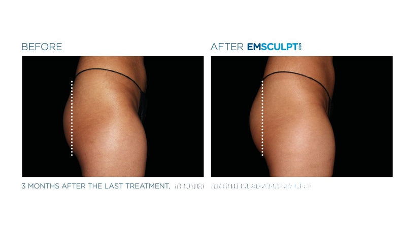 MEGASCULPT - EMSCULPTNEO X 20