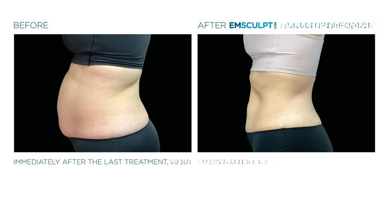 MEGASCULPT - EMSCULPTNEO X 20