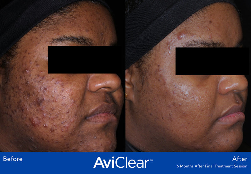 AviClear - Acne Treatment