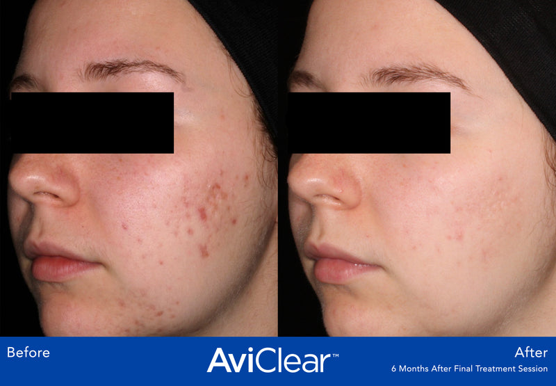 AviClear - Acne Treatment