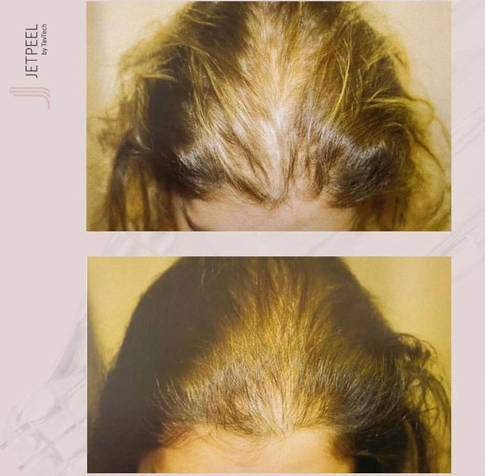 Jetpeel Hair Rejuvenation