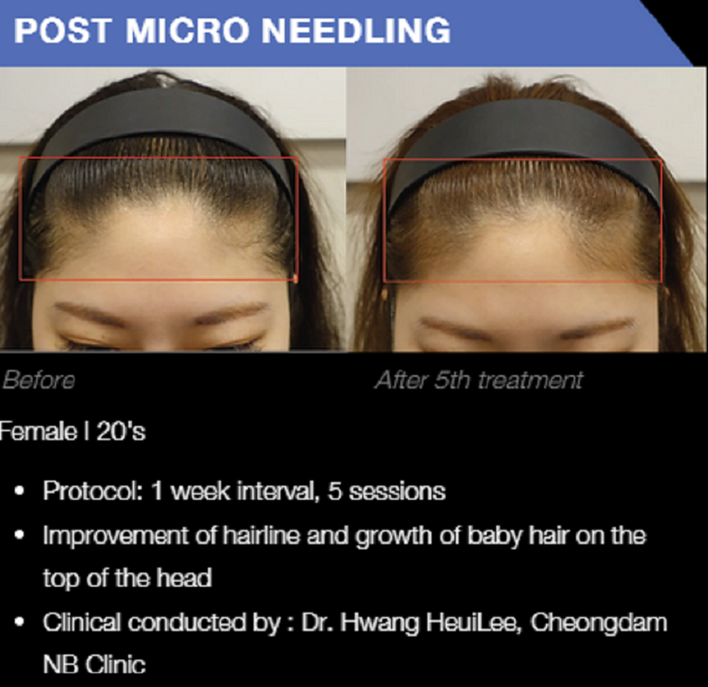 Exosome Microneedling Hair Therapy